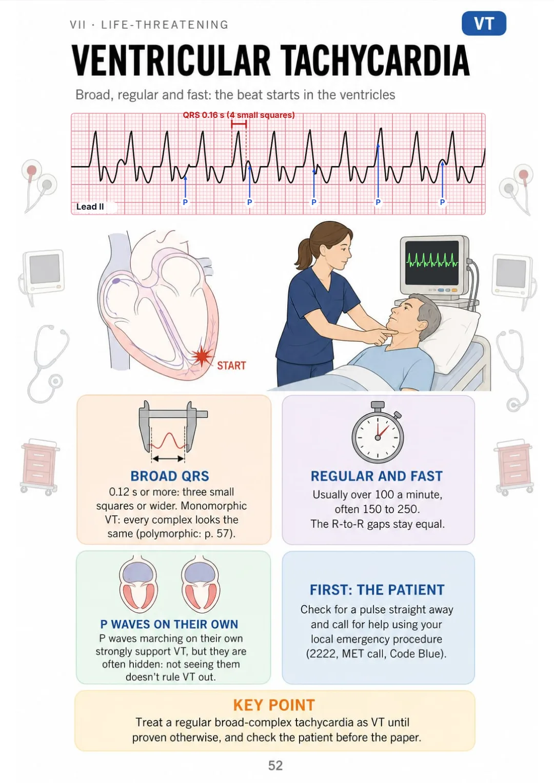 VT: QRS 0.12 s or more, regular, usually over 100 a minute; P waves may march on their own.