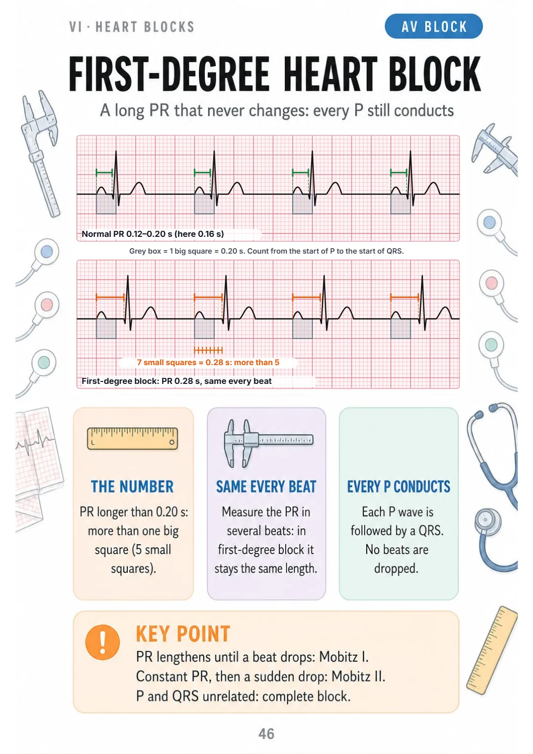 First-degree heart block: PR over 0.20 s, identical every beat, no dropped QRS.