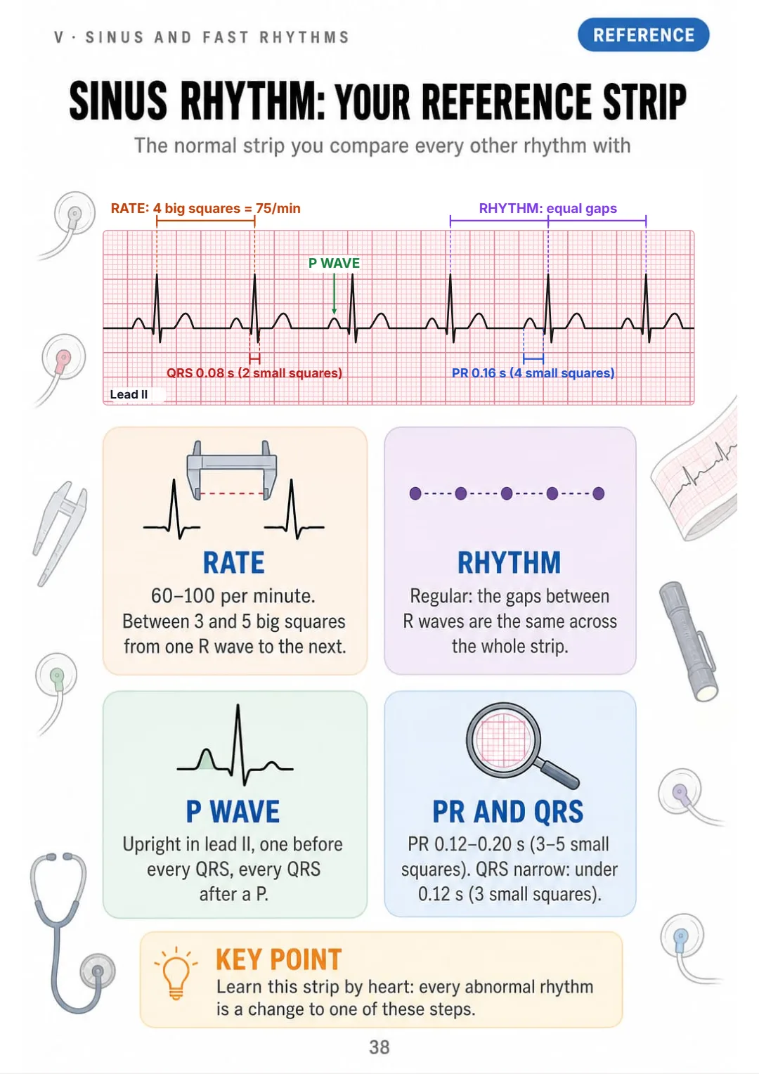 Sinus rhythm: rate 60–100, regular, upright P in II, PR 0.12–0.20 s, narrow QRS.