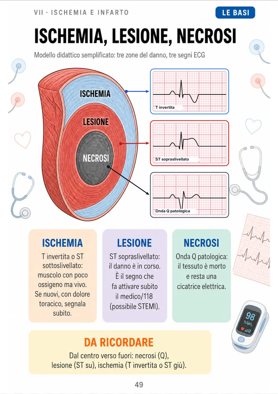 Ischemia = T invertita o ST giù · lesione = ST su · necrosi = Q patologica