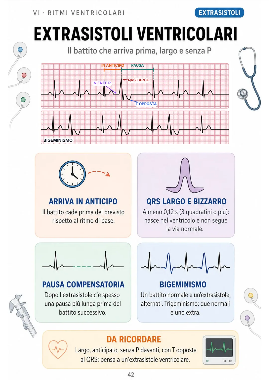Extrasistole ventricolare: QRS oltre 0,12 s, nessuna P davanti, T opposta e pausa dopo.